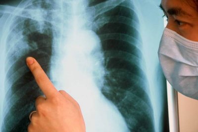 Новый опасный штамм туберкулеза обнаружен в Великобритании